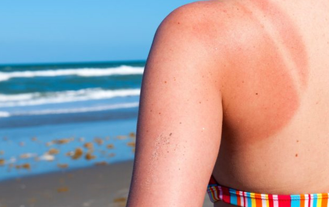 Know The Tips To Deal With Skin Problems Due To Sunburn.
